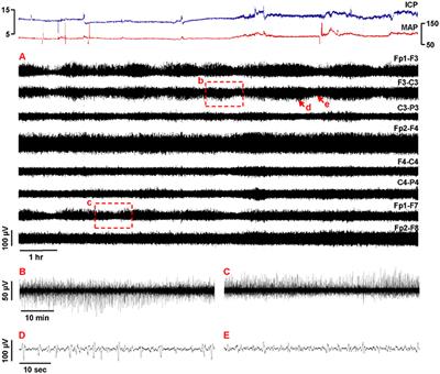 Commentary: Detecting Cortical Spreading Depolarization with Full Band Scalp Electroencephalography: An Illusion?